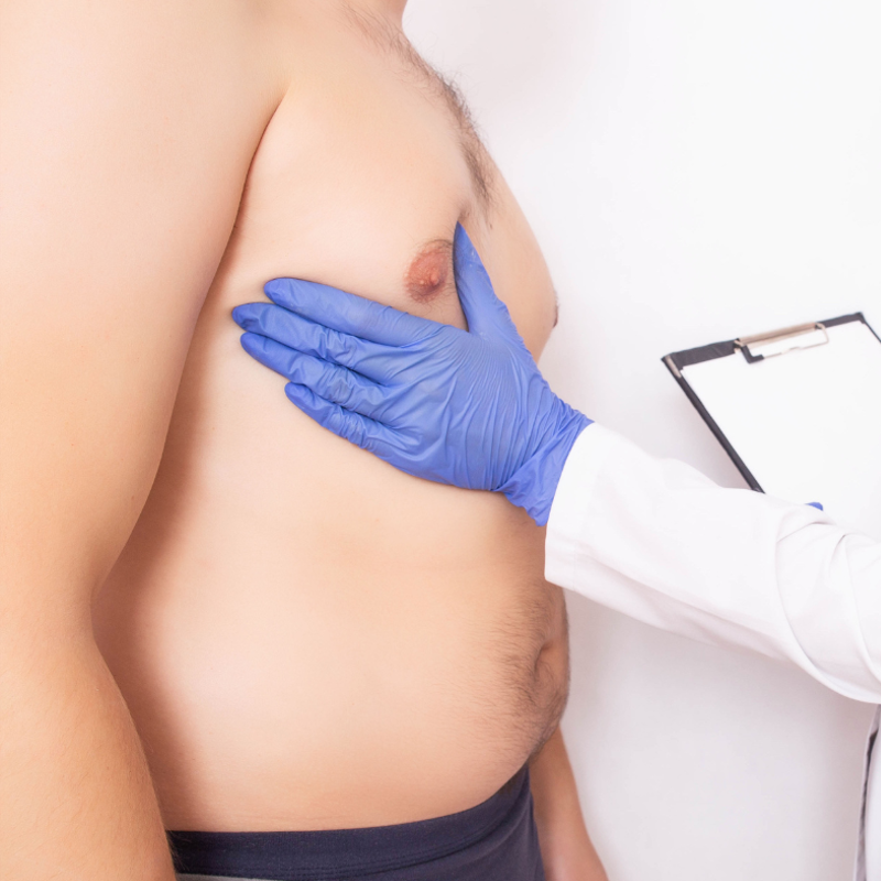 Gynecomastia