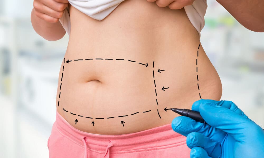 Tummy tuck