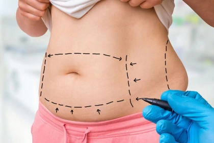 Tummy tuck