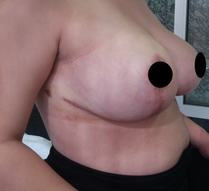 Breast reduction surgery