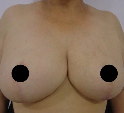 Breast reduction surgery