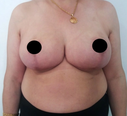 Breast reduction surgery