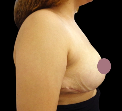 Breast reduction surgery