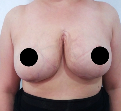 Breast reduction surgery