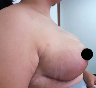 Breast reduction surgery