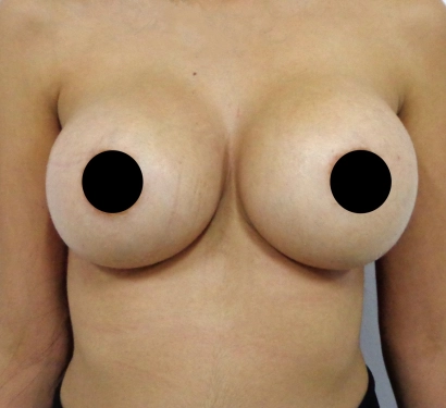 Breast enlargement surgery