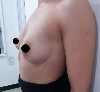 Breast enlargement surgery