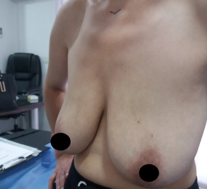 Breast lift surgery