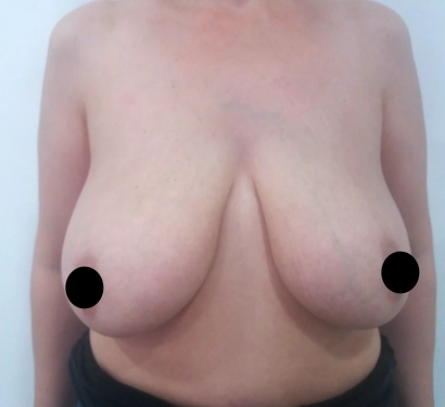 Breast lift surgery