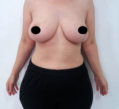 Breast lift surgery