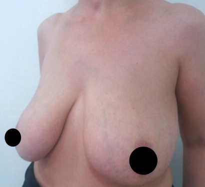 Breast lift surgery