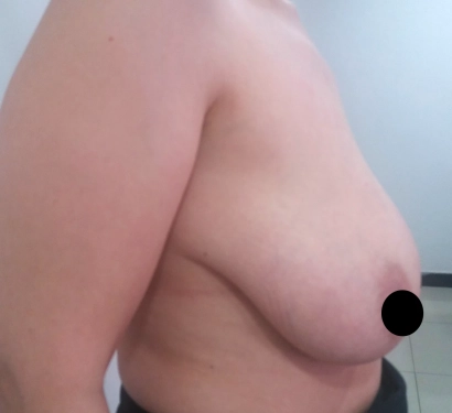 Breast lift surgery