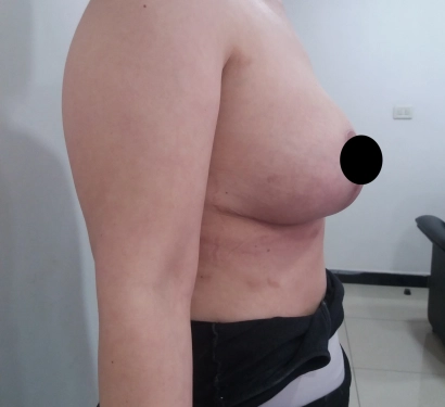 Breast lift surgery