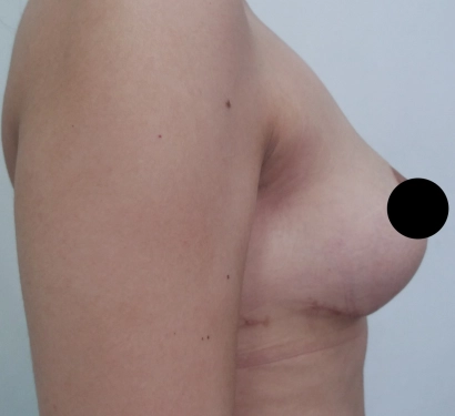 Breast lift surgery