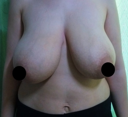 Breast lift surgery