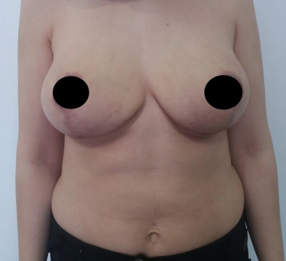 Breast lift surgery