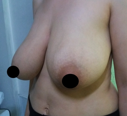 Breast lift surgery