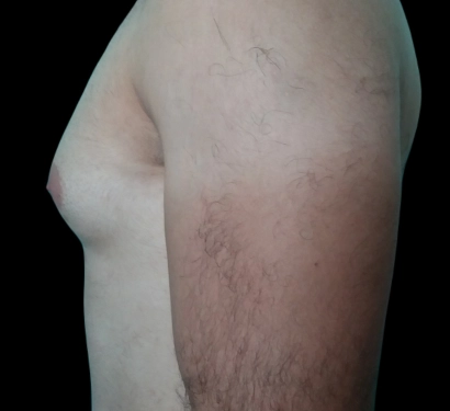 Gynecomastia