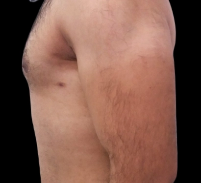 Gynecomastia