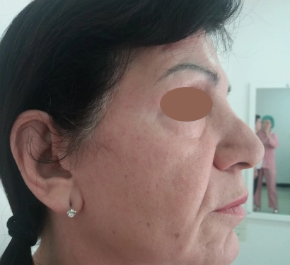 Facial fat injection