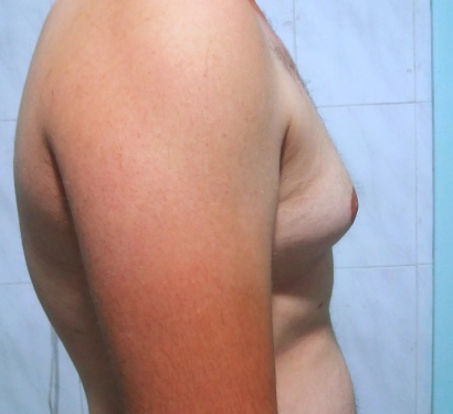 Gynecomastia