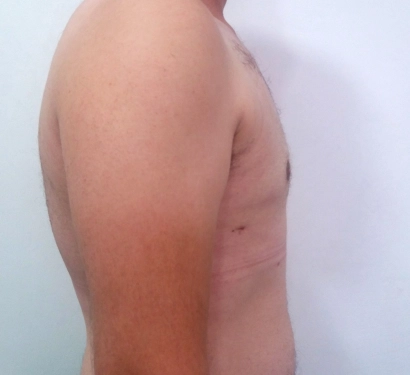 Gynecomastia