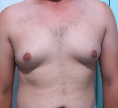 Gynecomastia