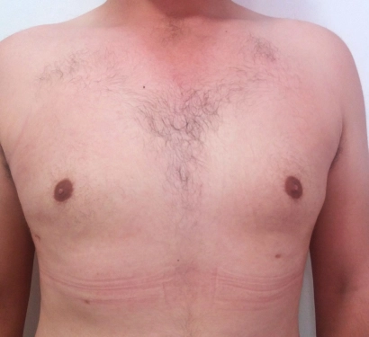 Gynecomastia