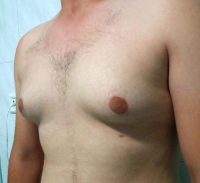 Gynecomastia