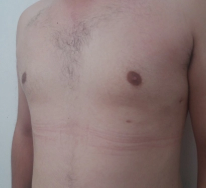 Gynecomastia