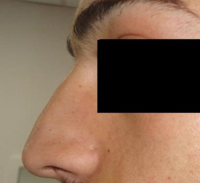 Rhinoplasty