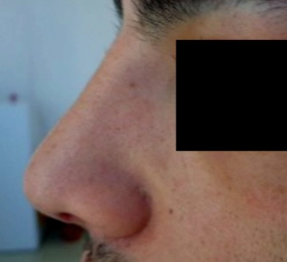 Rhinoplasty