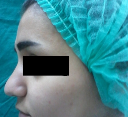 Rhinoplasty