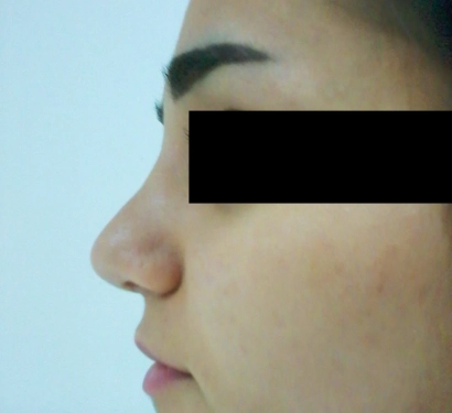 Rhinoplasty