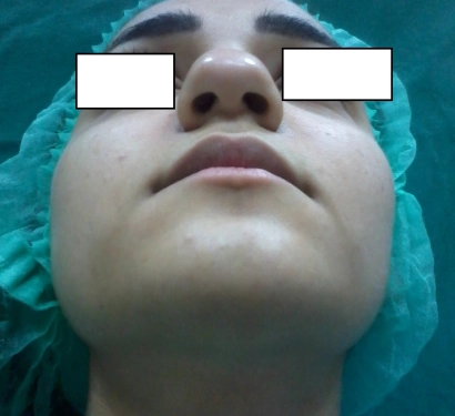 Rhinoplasty