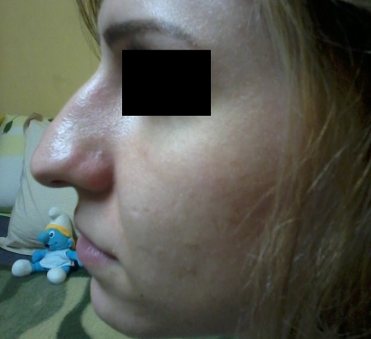 Rhinoplasty