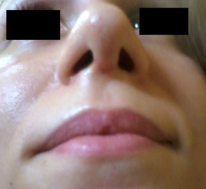 Rhinoplasty